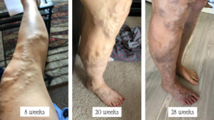 painful varicose veins during pregnancy
